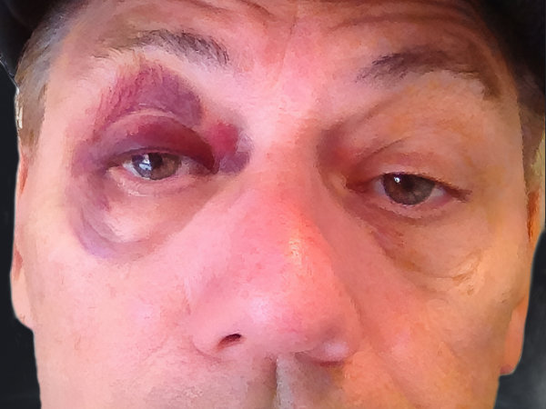 Neville with Black eye