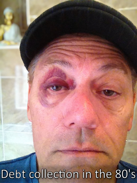 Neville with black eye